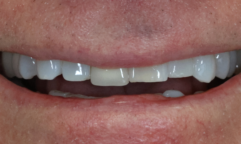 Close-up of a person's smile showing slightly uneven upper front teeth and lips.