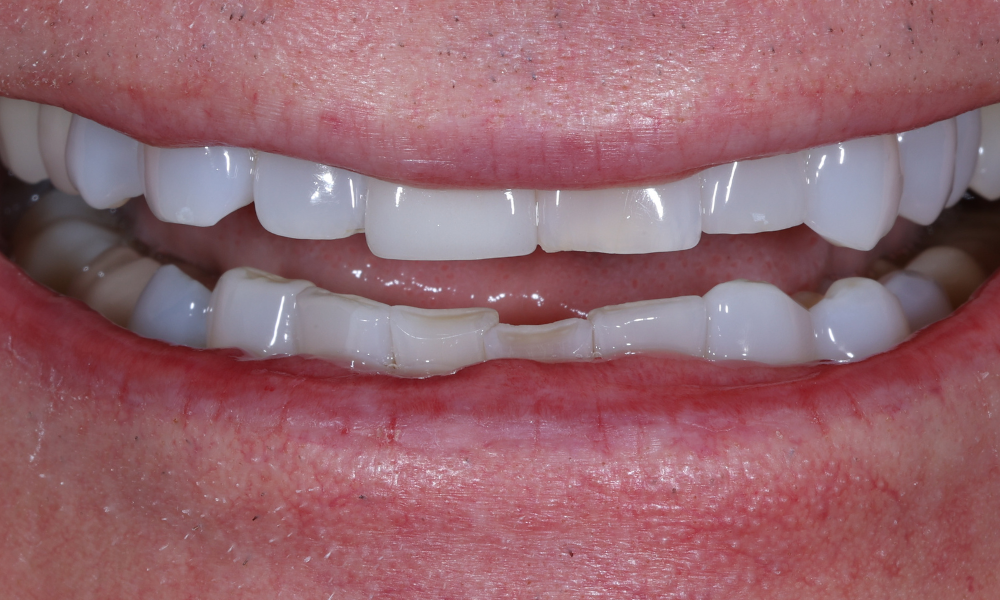 Close-up of a person's mouth showing upper teeth with dental crowns and lower teeth with worn, damaged enamel.