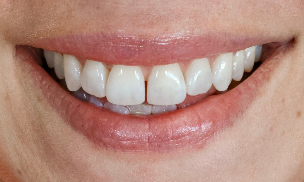 Close-up of a smiling mouth showing slightly misaligned upper front teeth with a small gap between the two central incisors.