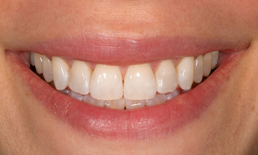 Close-up of a smiling mouth showing clean, white, and straight upper front teeth.