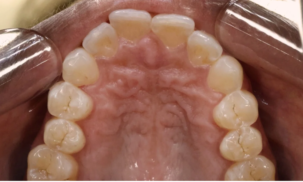 Close-up of upper teeth and palate showing natural teeth alignment and detailed palate texture.