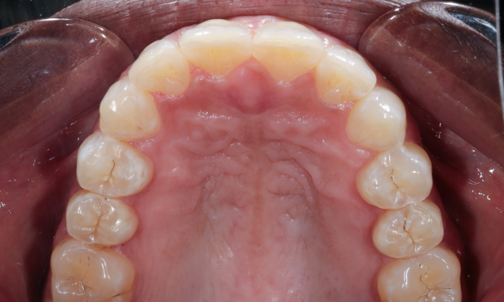 Close-up view of the upper dental arch showing healthy teeth and pink gums.