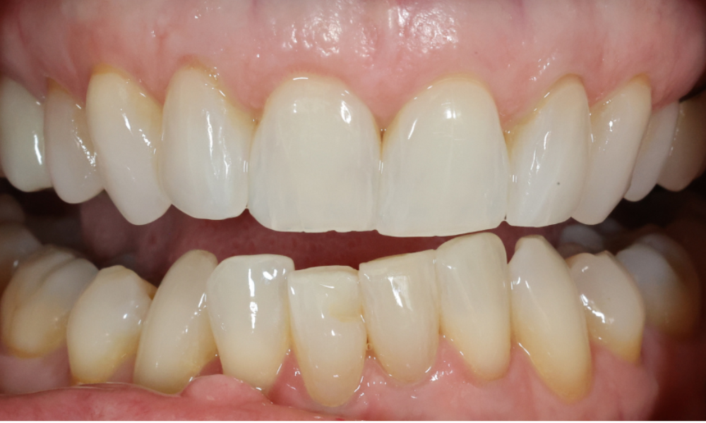 Close-up of upper and lower teeth showing slight crowding and uneven alignment on lower front teeth.