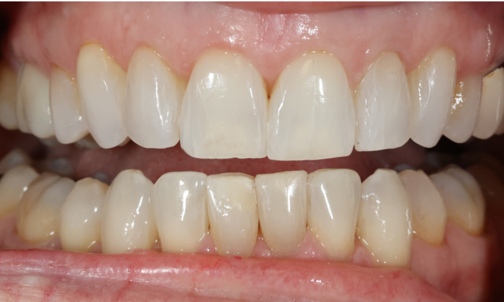 Close-up of slightly smiling mouth showing clean upper and lower teeth with a small gap between the two upper front teeth.