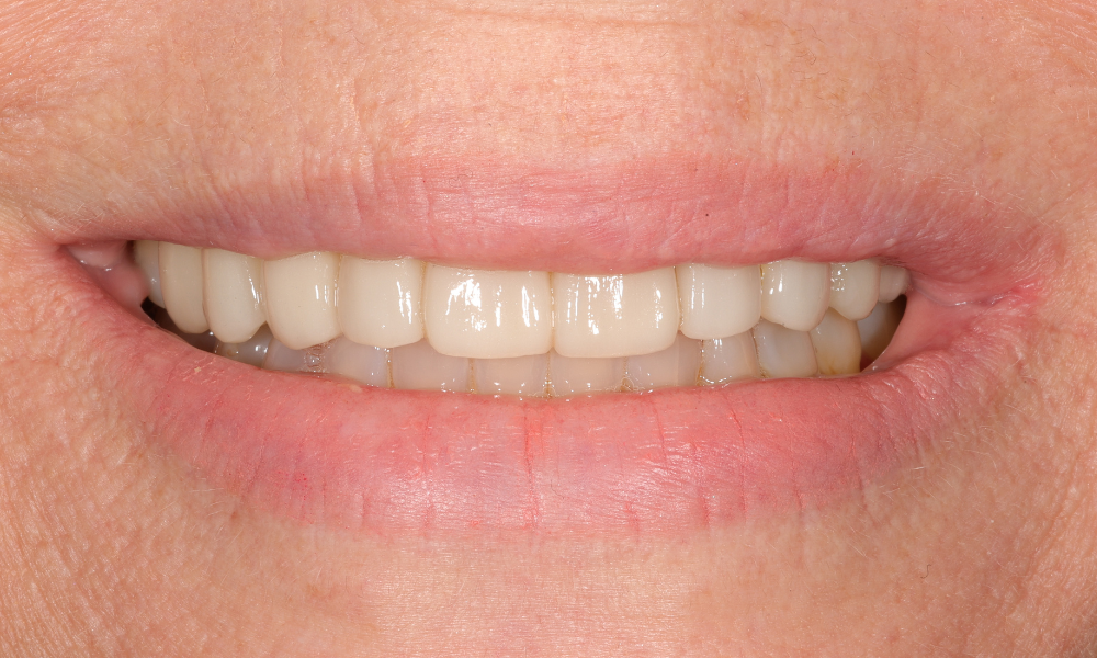 Close-up of a person's mouth showing upper teeth with dental veneers and a slight smile.