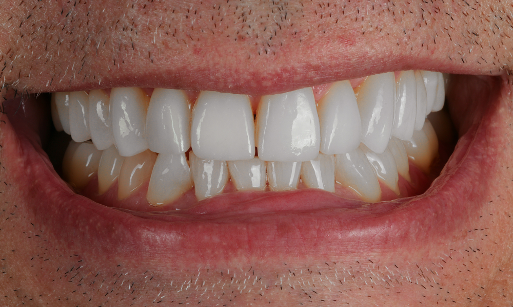 Close-up of a person's mouth showing upper and lower teeth with dental veneers on the upper front teeth.