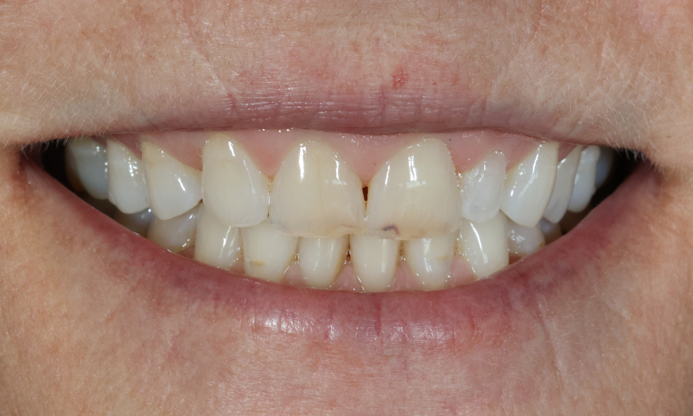 Close-up of a smile showing natural teeth with discoloration and minor stains on the upper front teeth.