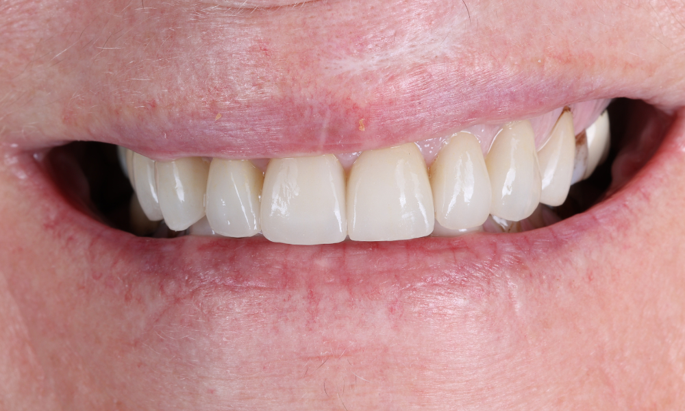 Close-up of a person's smile showing clean, well-aligned upper teeth and natural lips.