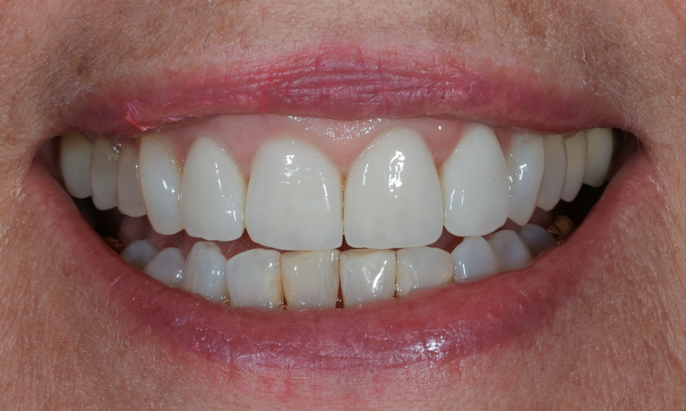 Close-up of a smiling mouth showing clean, bright upper front teeth and slightly discolored lower front teeth.