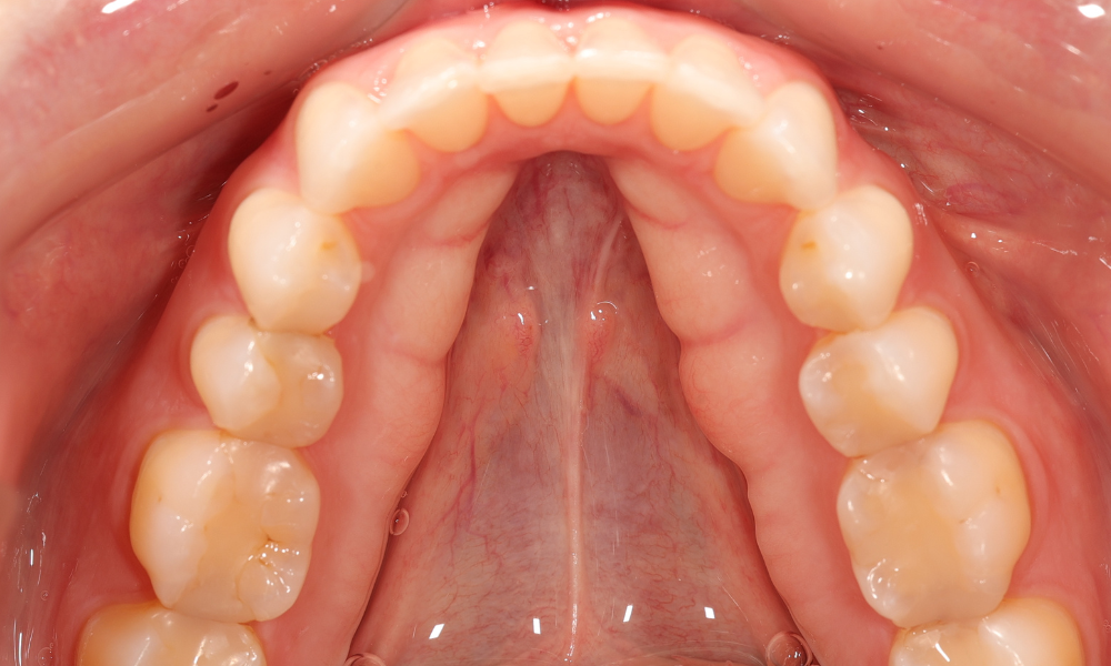Close-up of the upper dental arch with healthy teeth and gums.