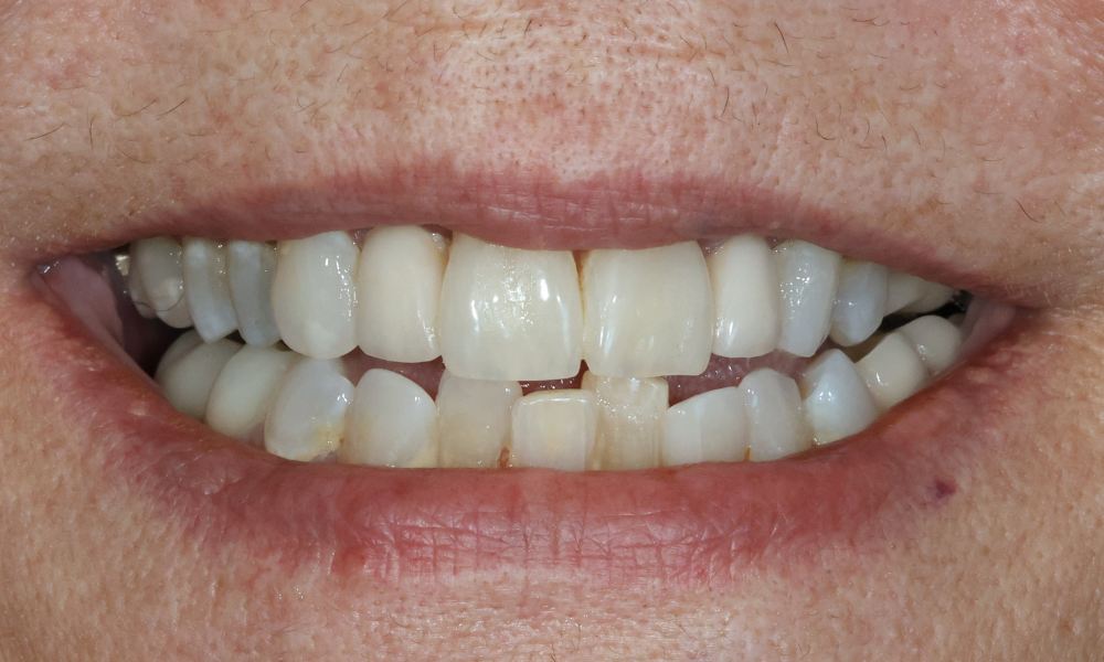 Close-up of a smile showing teeth with noticeable gaps and discoloration.