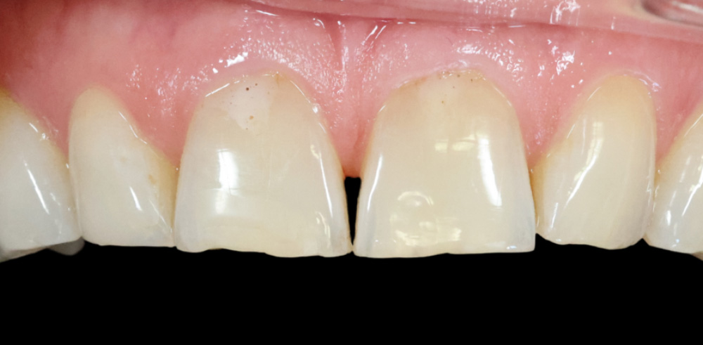 Close-up of upper front teeth with visible discoloration, chips, and staining on enamel.