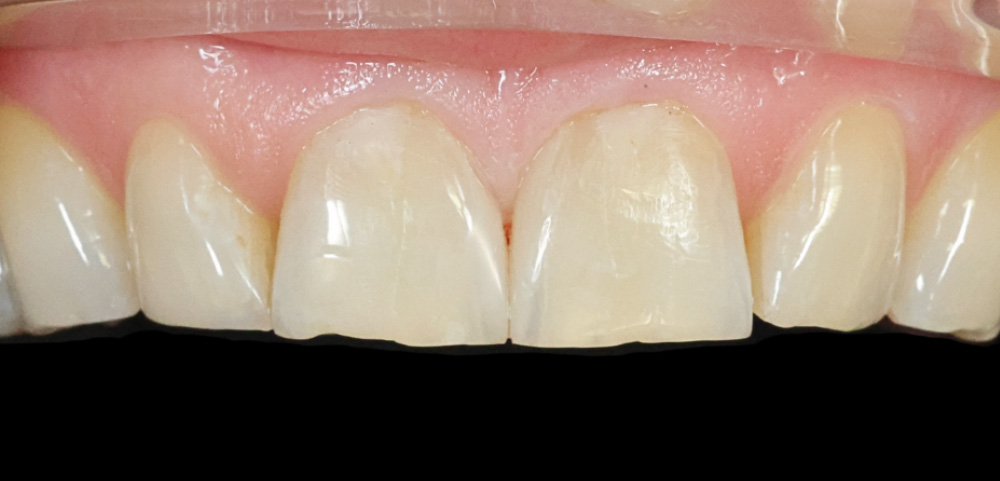Close-up of upper front teeth with cosmetic dental bonding on two central incisors.