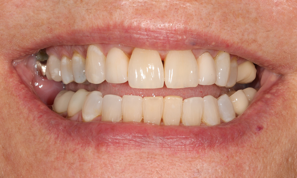 Close-up of a person's smile showing upper and lower teeth with a dental crown visible on the left side.