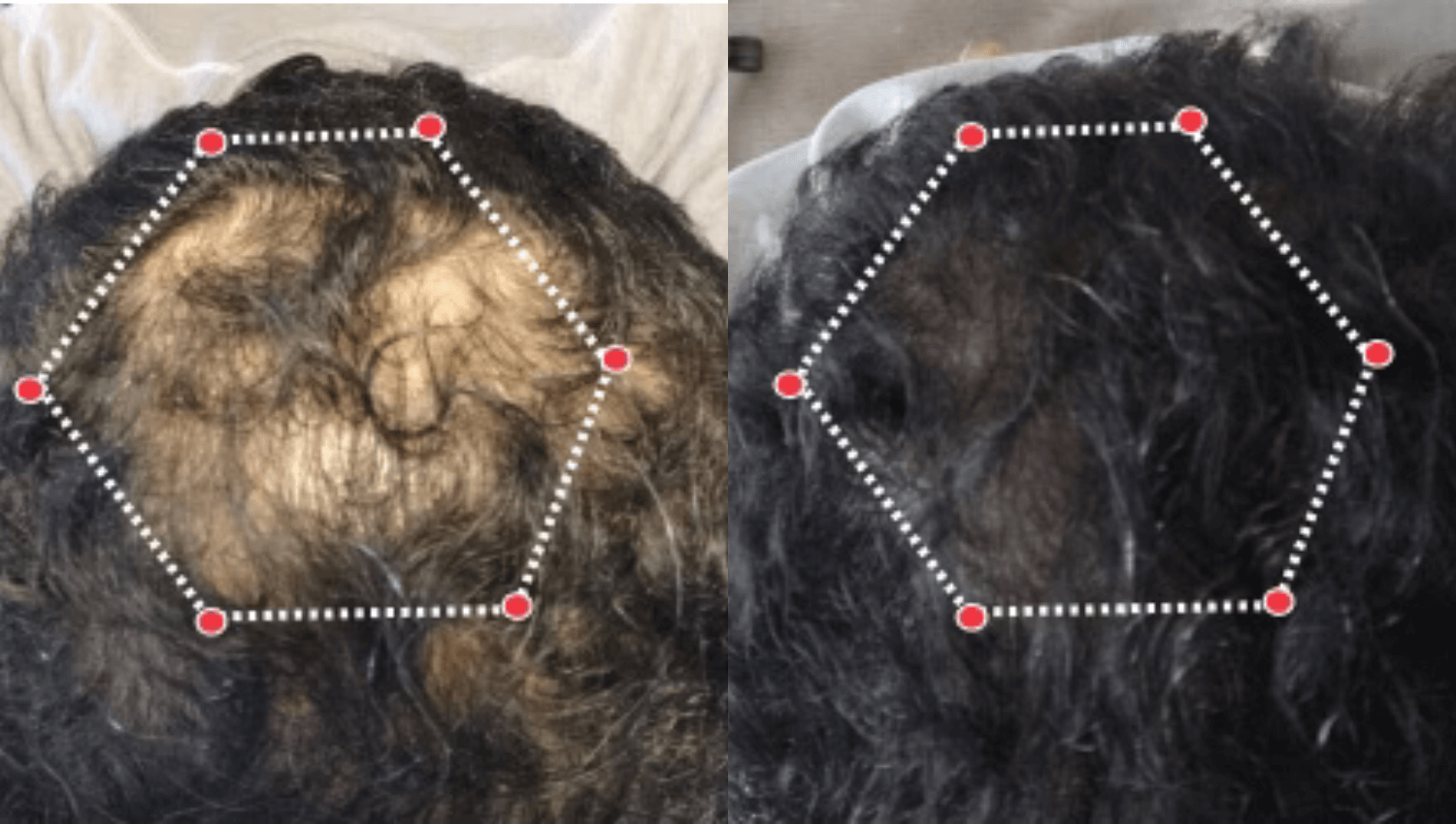 calvitie du sommet atténuée, densité capillaire améliorée après thérapie LED (résultats clients)