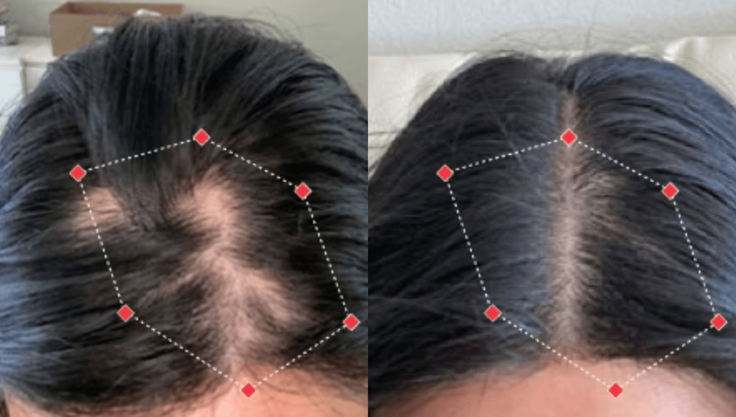 raie moins élargie et densité renforcée après protocole photobiomodulation LED (résultats)