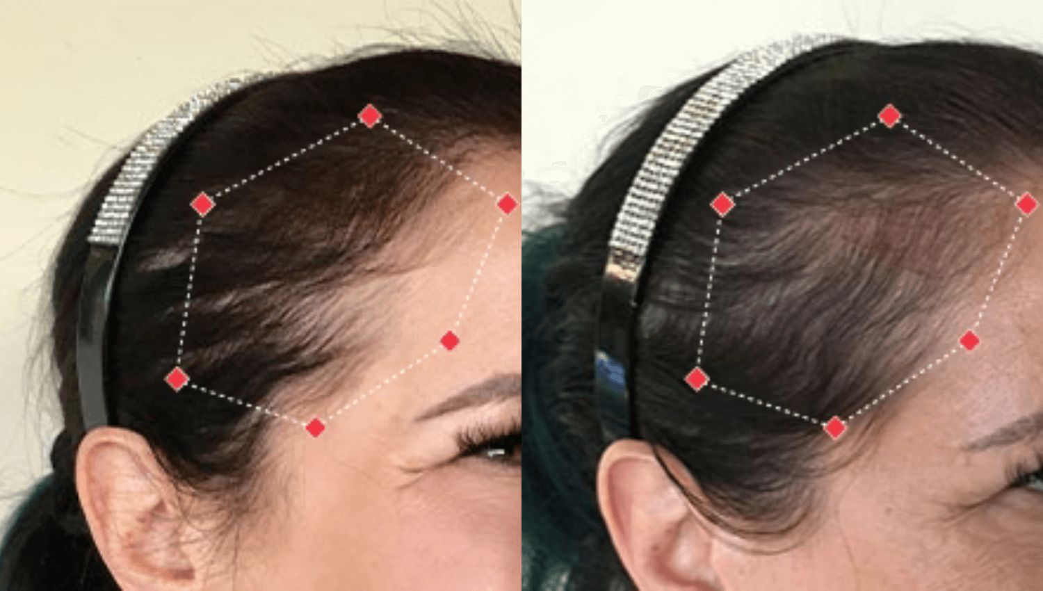 ligne frontale plus dense après photobiomodulation LED (résultats réels)
