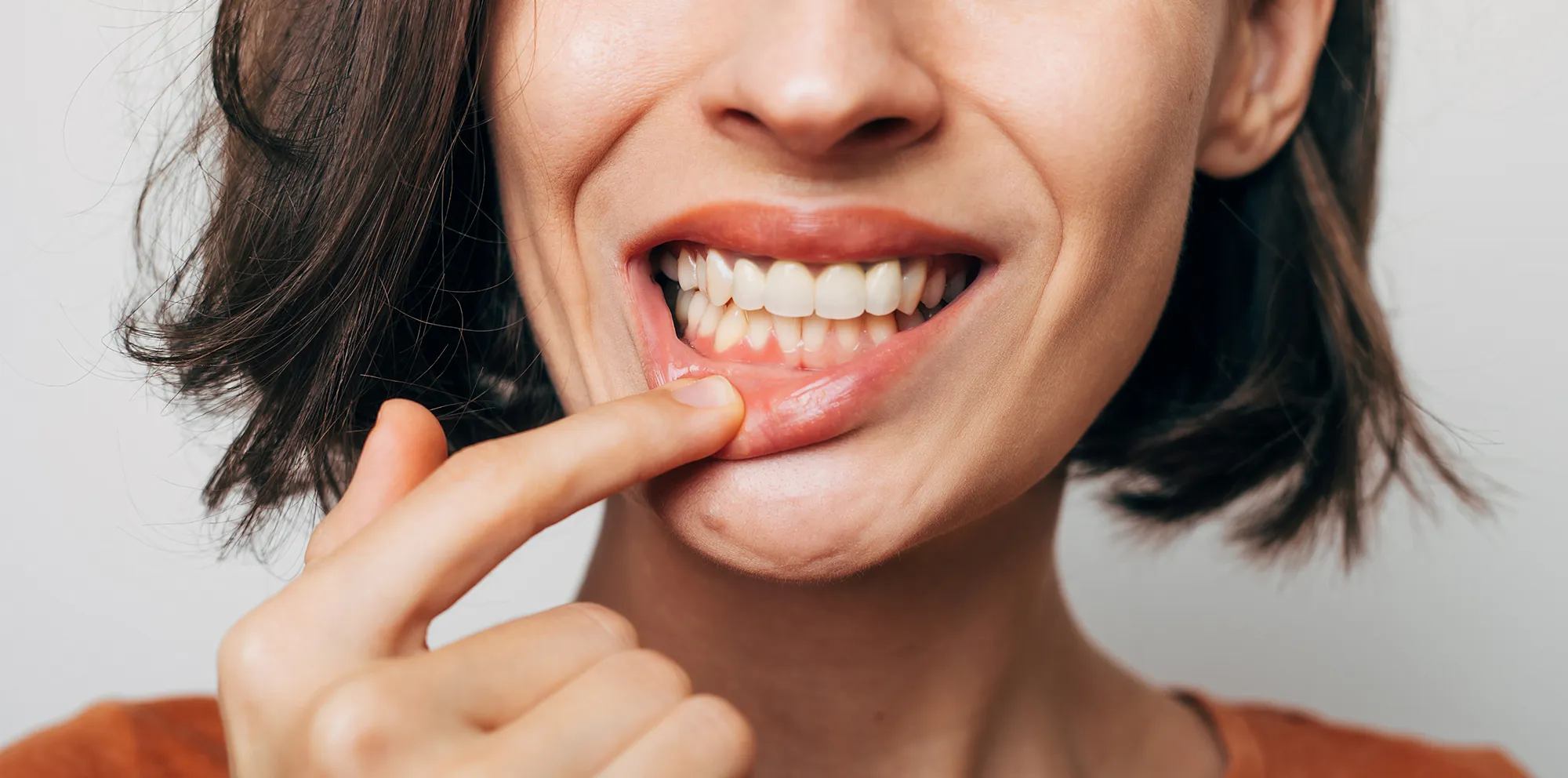 Gingivectomy (Gum Contouring) at Haven Cosmetic Dentistry & Implant Center