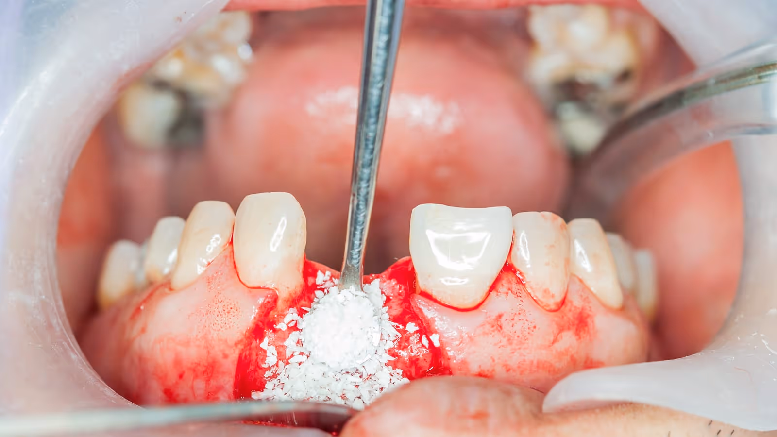 Socket preservation and bone grafting procedure to maintain bone structure after extraction