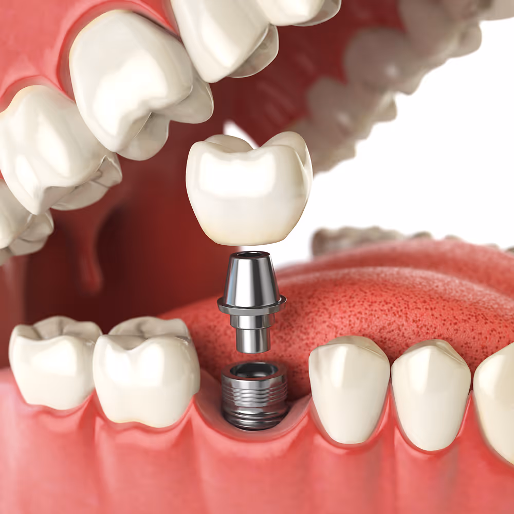 Dentures anchored with implants for improved stability, comfort, and chewing ability