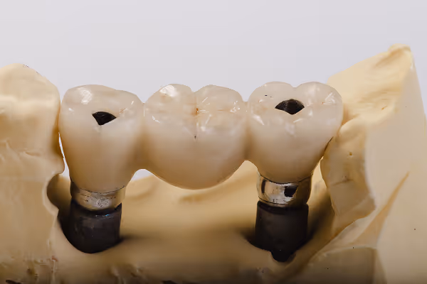 Implant-supported bridge replacing multiple missing teeth without affecting surrounding teeth
