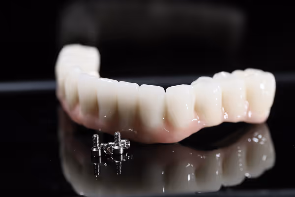 All-on-4 full arch implant system providing secure, fixed teeth replacement for an entire jaw