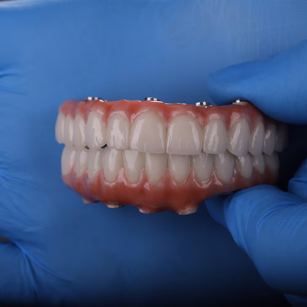 Illustration showing how All-on-X implants support a full arch of replacement teeth