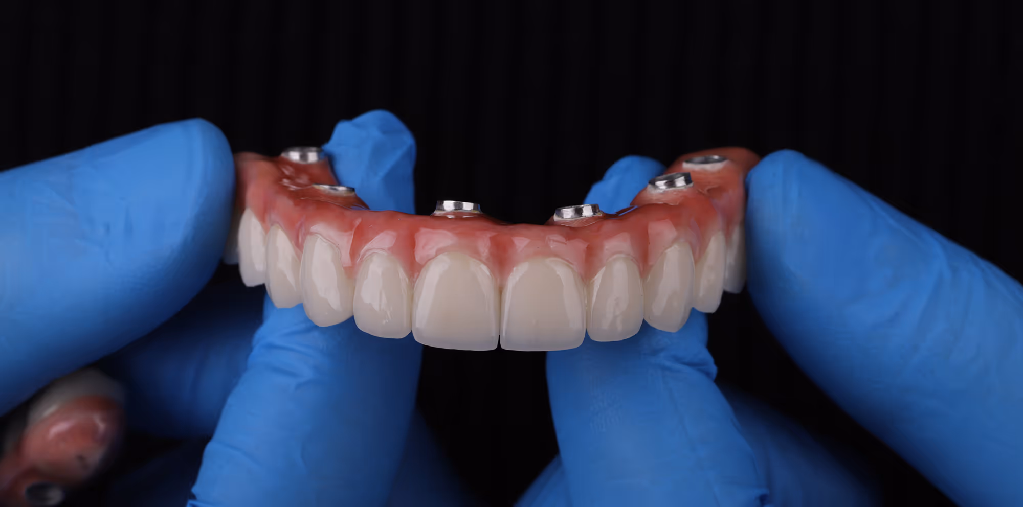 All-on-X Implants at Haven Cosmetic Dentistry & Implant Center