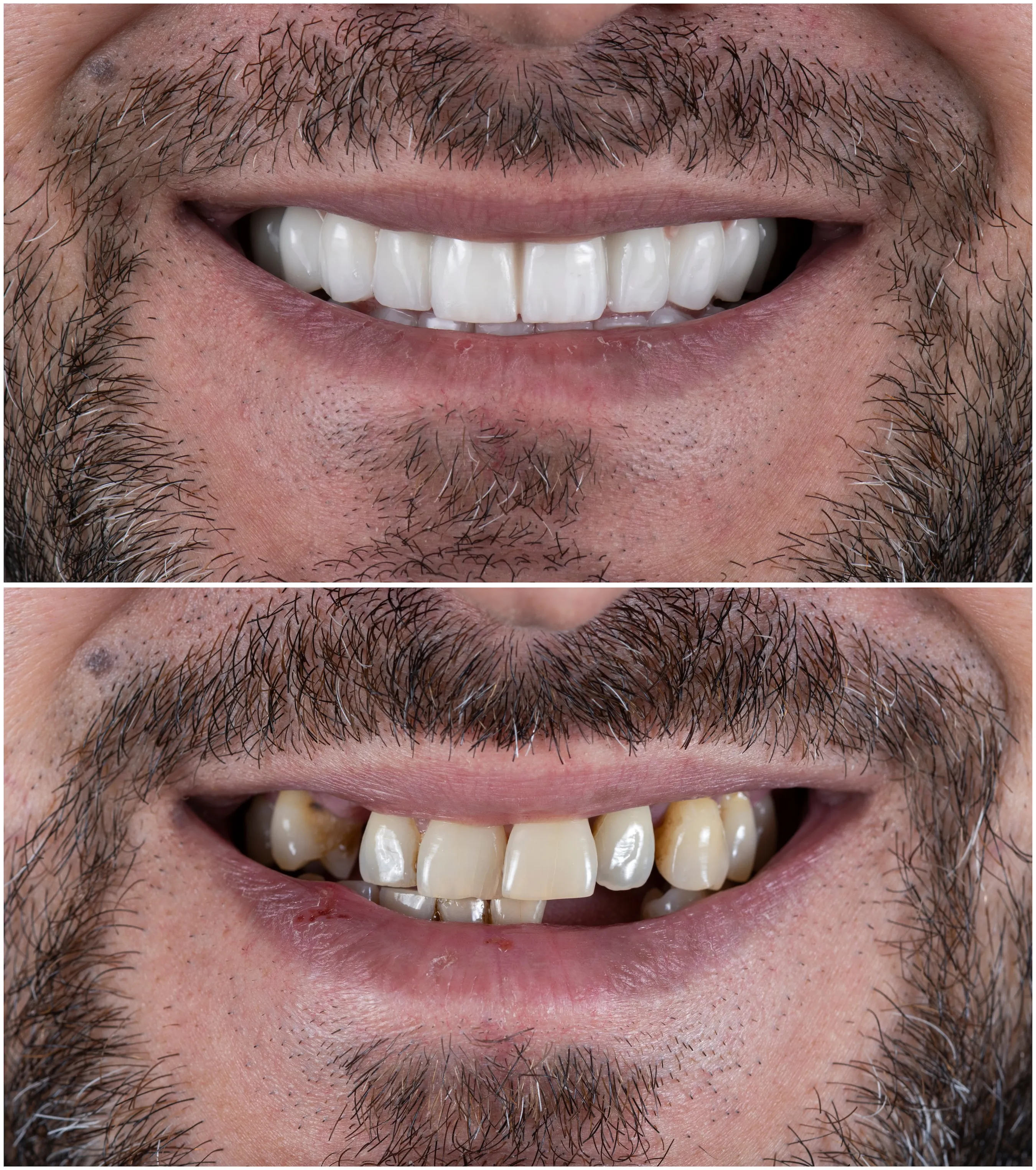 ceramic crowns on implant bridges