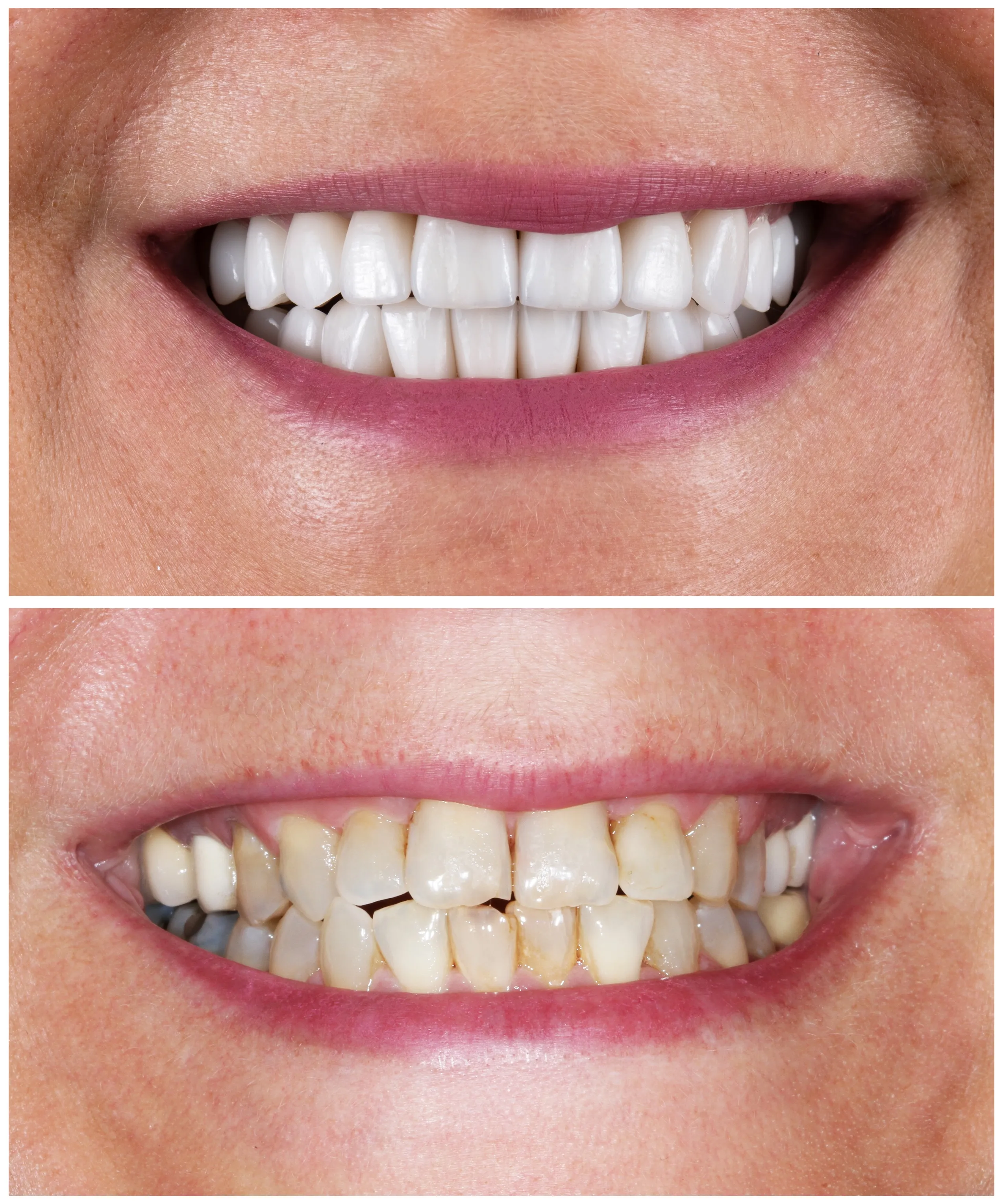 emax ceramic crowns and veneers
