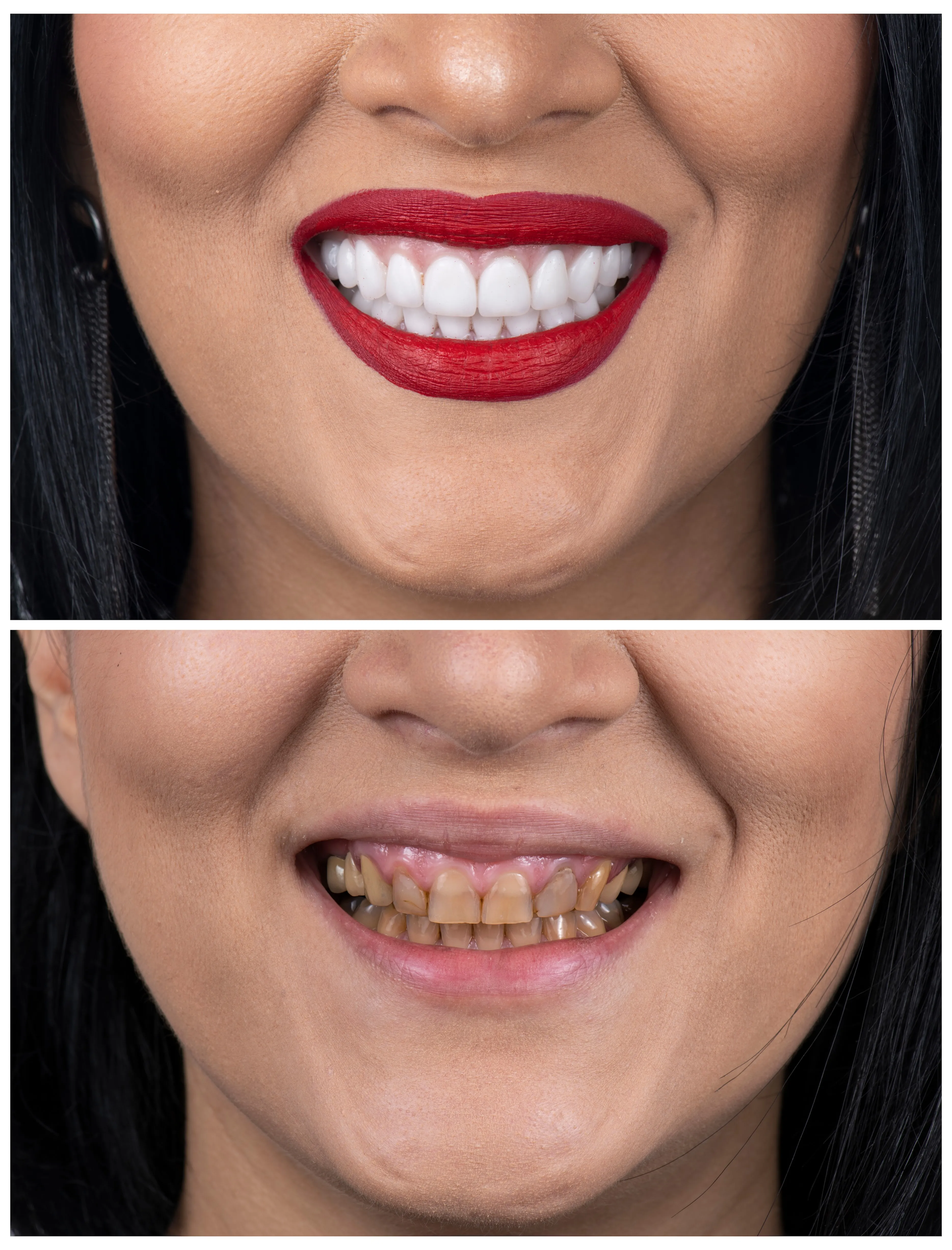 crowns veneers implants