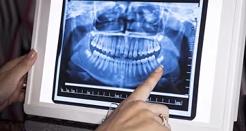 Person pointing at a dental X-ray image showing upper and lower teeth and jawbones.