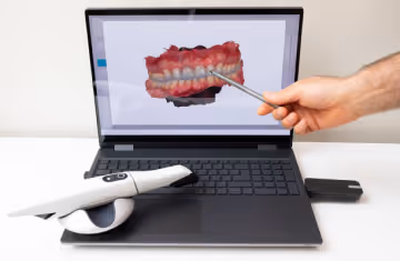 Close-up of a dental 3D scan of teeth displayed on a laptop, with a hand pointing at the screen using a dental tool and an intraoral scanner resting on the laptop keyboard.