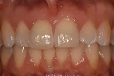 Close-up of upper and lower teeth with slight gaps and healthy gums.