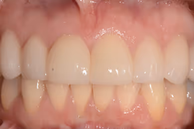 Close-up of a person's upper and lower front teeth with visible gums.