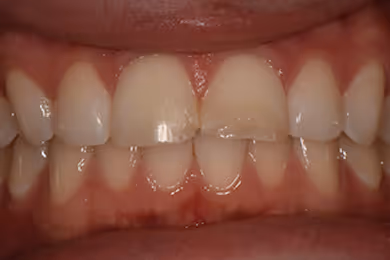Close-up of teeth with a chipped upper front tooth and healthy gums.