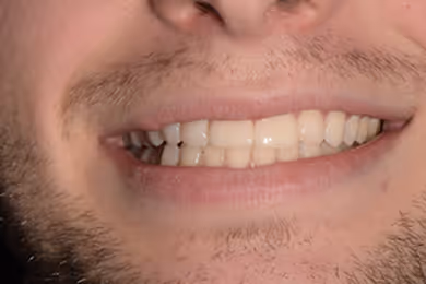 Close-up of a smiling person's mouth showing teeth and light facial hair.