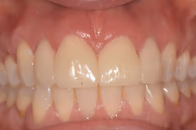 Close-up of a person's mouth showing straight, healthy upper and lower teeth with gums visible.
