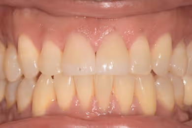 Close-up of a person's teeth with orthodontic braces and clear aligners.