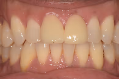 Close-up of teeth showing discoloration and unevenness with a focus on the front upper and lower teeth.
