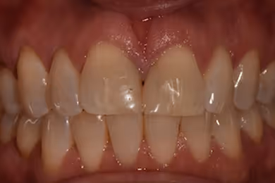 Close-up view of a person's slightly misaligned upper and lower front teeth and gums.