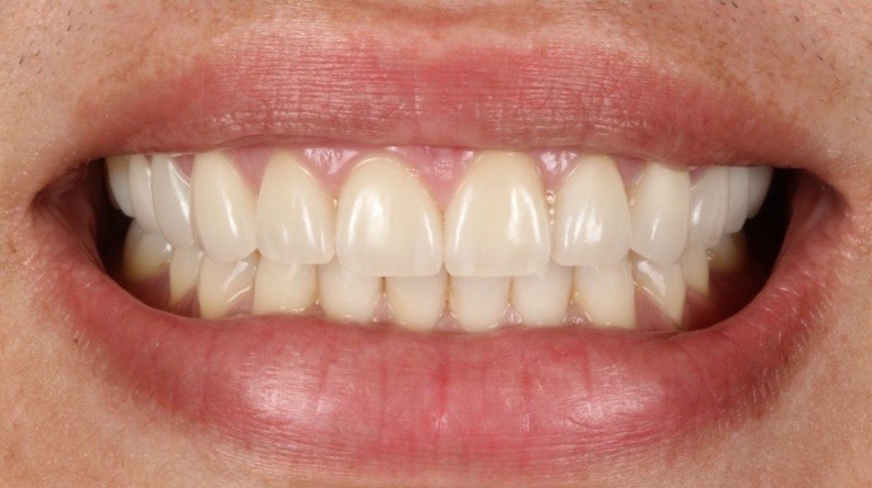 After, Smile design