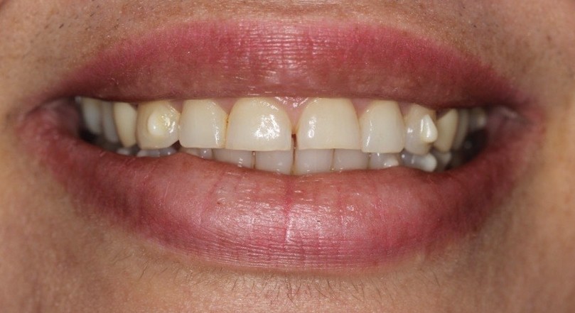 Before, Smile design