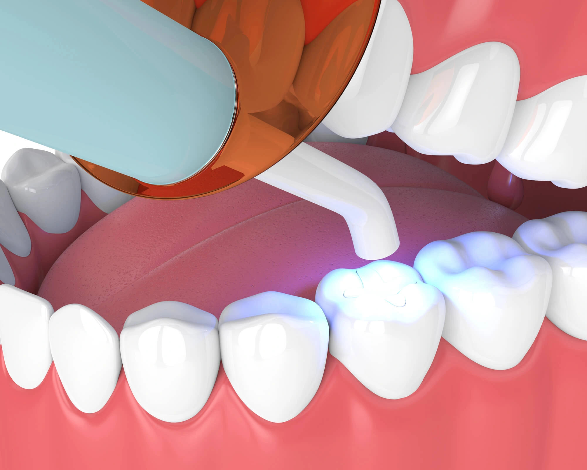 tooth fillings lansdale_
