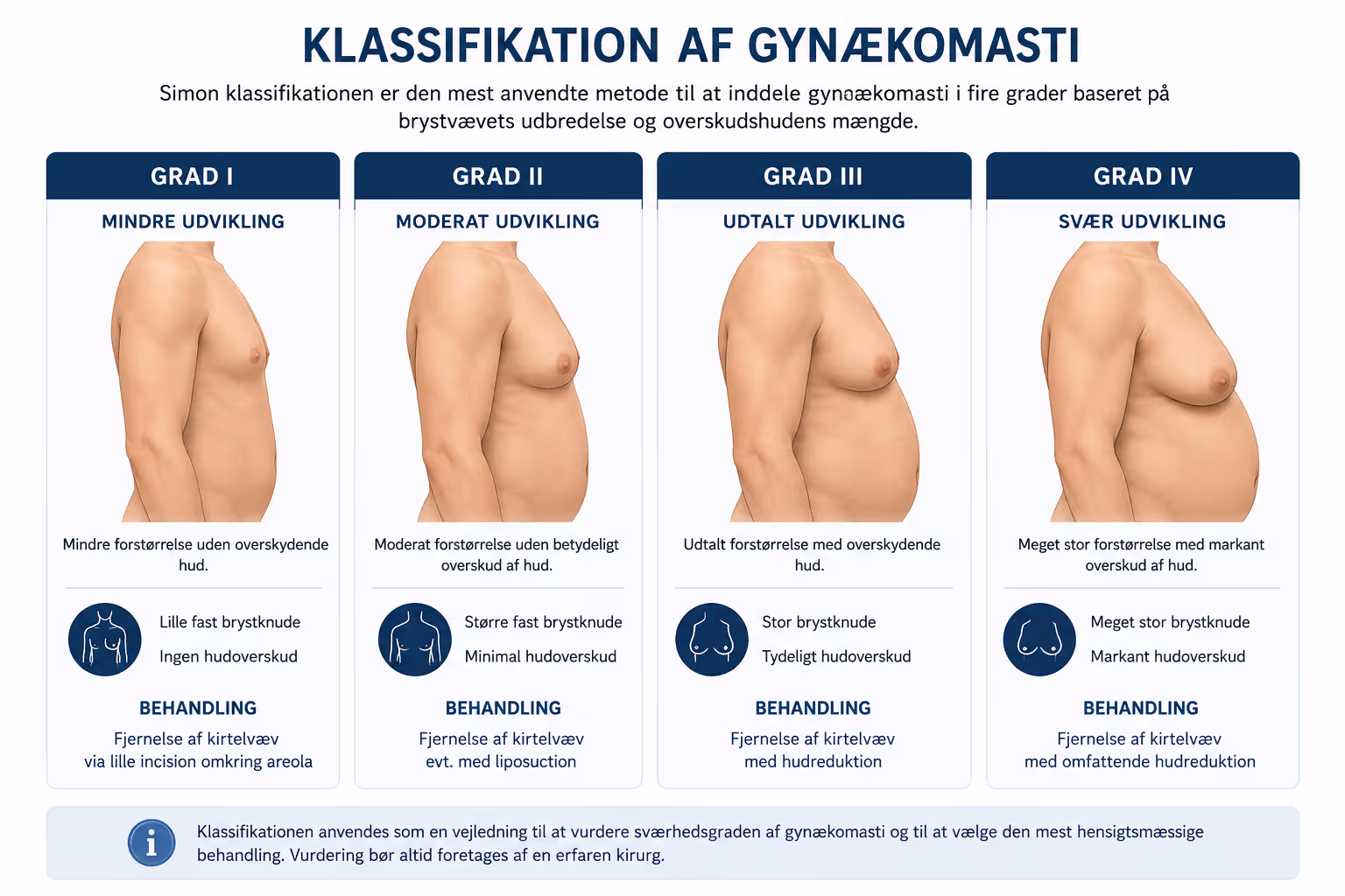 Klassifikation af gynækomasti i fire grader vist som brystprofiler set fra siden, fra mindre udvikling til svær udvikling, med tilhørende behandling for hver grad