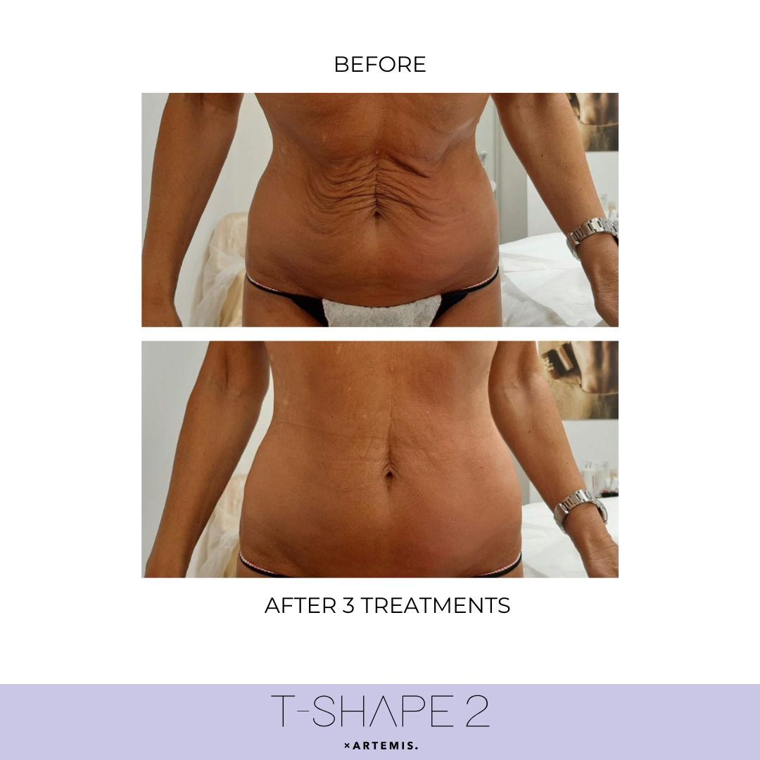 T-Shape 2 body contouring treatment at Shrout Wellness med spa in Carmel, IN