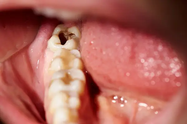 What does Vital Pulp Therapy mean for patients?