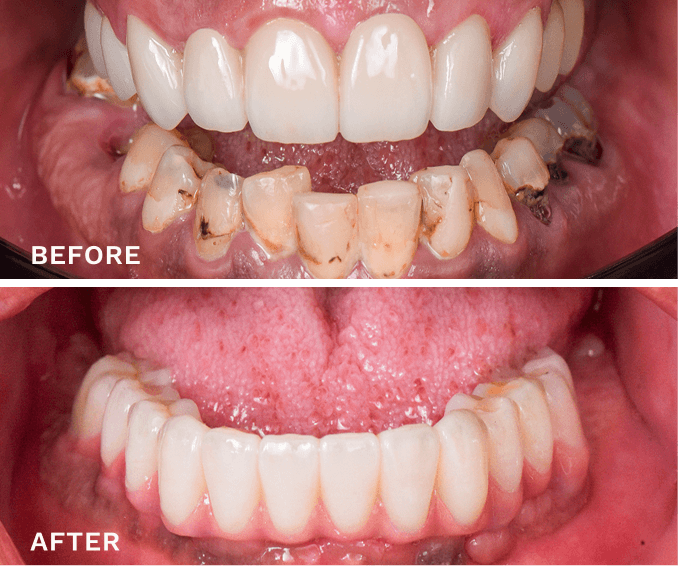 Before and after images of lower teeth showing severe decay and discoloration in 'before' and clean, restored teeth in 'after'.