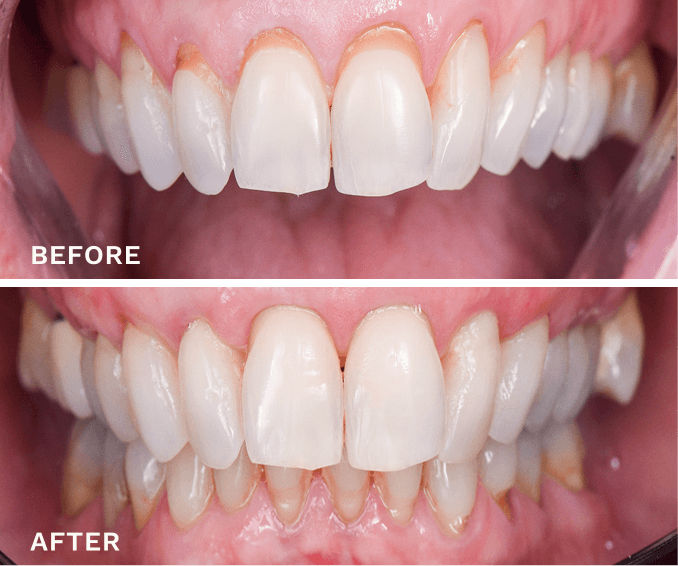 Close-up comparison of upper front teeth before and after treatment showing improved gum coverage and reduced gum recession.
