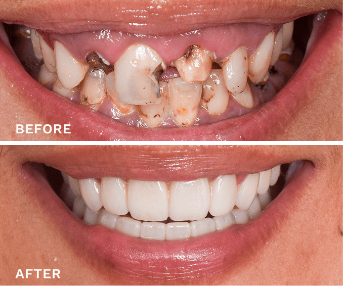 Before and after close-up of a smile showing severely decayed teeth replaced by clean, evenly shaped white teeth.